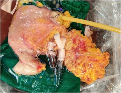 Normothermic Ex Vivo Machine Perfusion of Discarded Human Pancreas Allografts: A Feasibility Study